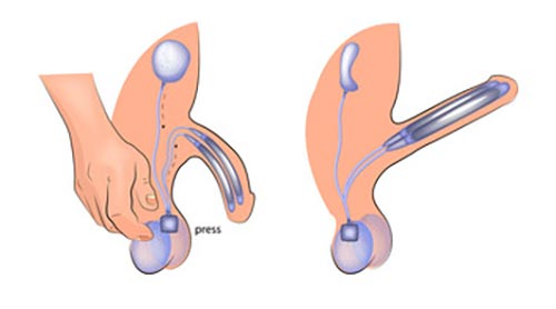 Penile Prostheses | Australian Urology Associates