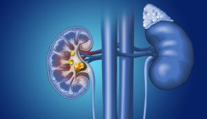 Kidney Stones diagnosis and treatment Australian Urology Associates